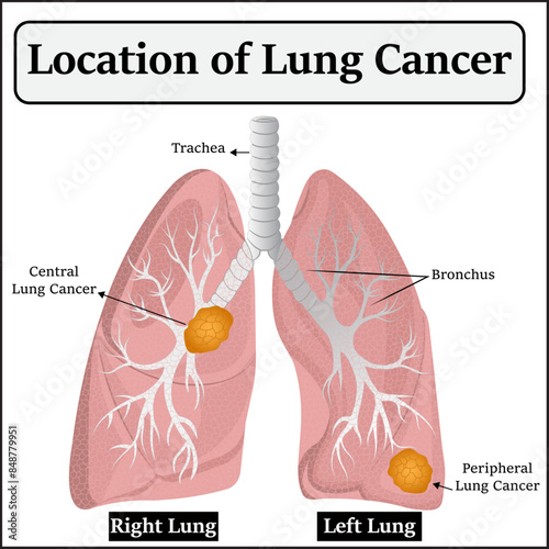 Location of Lungs Cancer vector Diagram