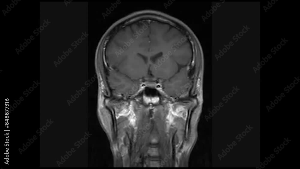 Front View of MRI Brain Scan, magnetic Resonance Imaging to diagnosis disease. Science, Healthcare and medical concept. Front View of MRI Brain Scan, magnetic Resonance Imaging to diagnosis disease. Science, Healthcare and medical concept.