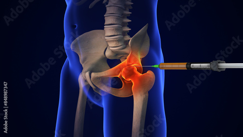 Anatomy Human Hip Joint Treatment