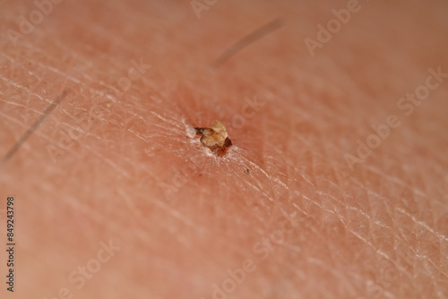 Photography close-up of a scab on skin