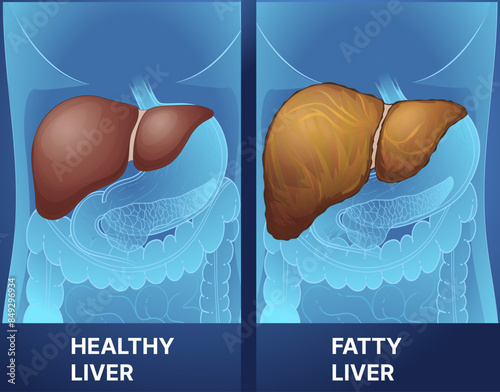 Human liver disease. Healthy liver, fatty liver. Healthcare illustration. Vector illustration.