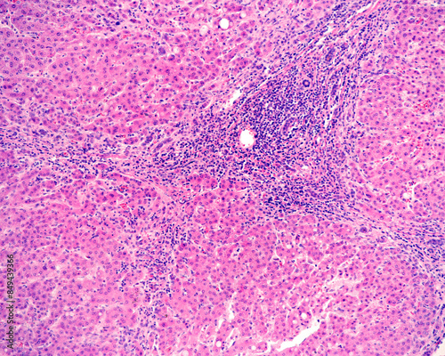 Human liver. Cirrhosis photo
