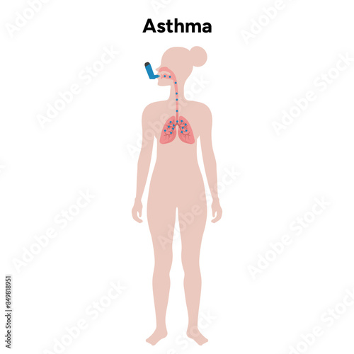 Lungs asthma in human