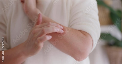 The Woman Applies Ointment to Alleviate the Symptoms of the Bite Her Hand Is Swollen and Edematous photo
