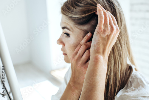 Psoriasis, a skin disease in a young woman. Hair problems.