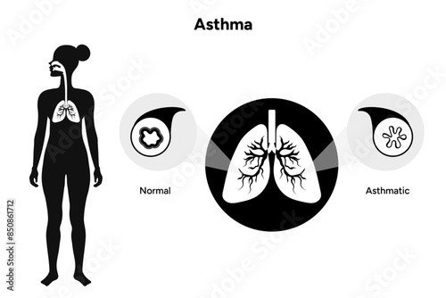 Asthmatic airways lungs in icons
