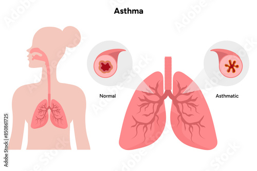 Lungs asthma in human medical diagram