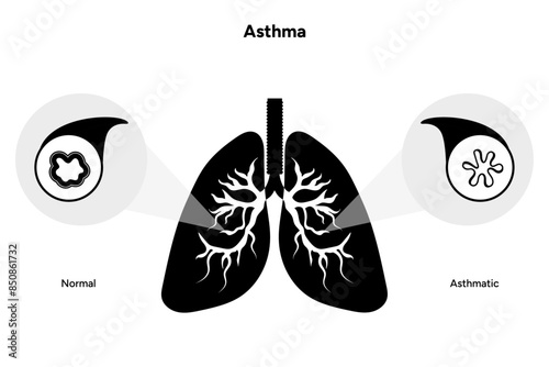 Asthmatic airway disease lungs in icons