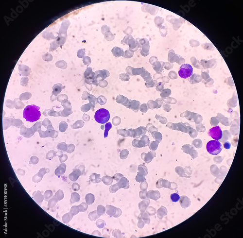 Bone marrow study(BMS): Lymphocytosis with clumped chromatin. Pancytopenia in PBF. Lymphoproliferative disorders. Lymphoproliferative disease. photo