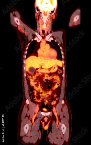 A PET CT scan image shows comprehensive views of organs and tissues.