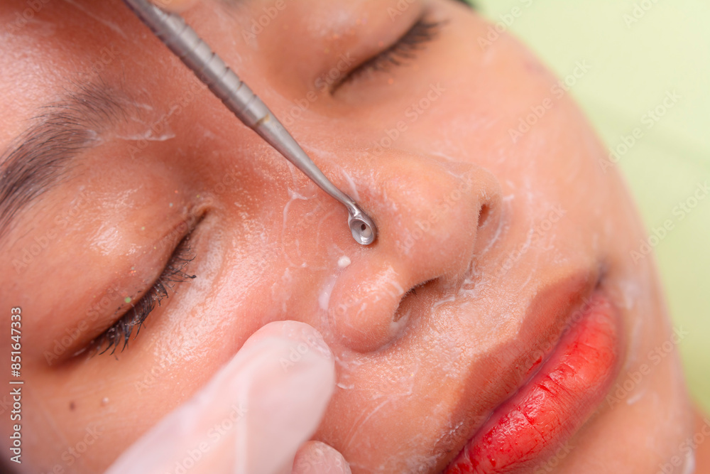 Fototapeta premium Close-up of a person receiving a facial comedone extraction treatment at an aesthetic clinic, focusing on skin care and hygiene.