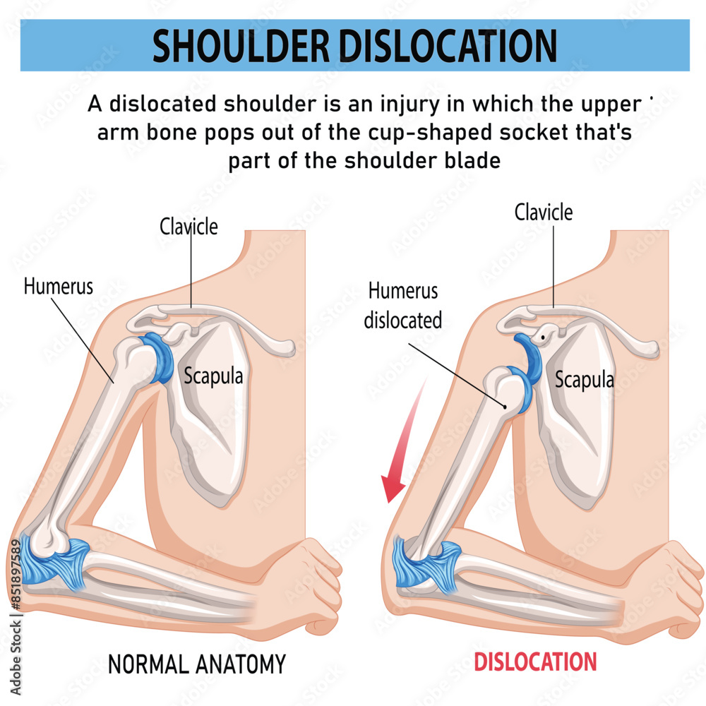 vetor-de-shoulder-dislocation-and-humerus-bone-trauma-explanation
