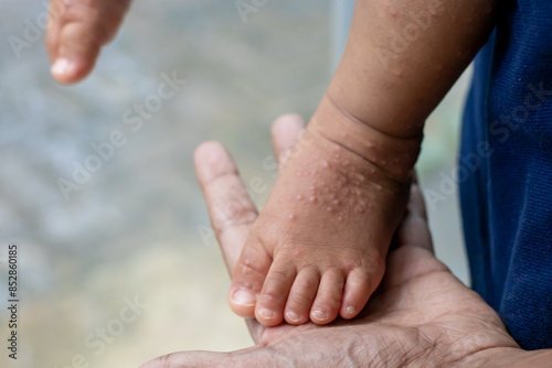 hand with hand-foot-mouth disease infected child's feet on an adult hand or HFMD originating from enterovirus or coxsackie virus, care for hand foot mouth disease photo