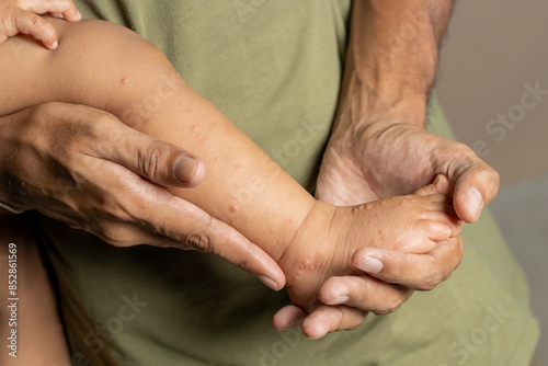 father holding the leg of a HFMD infected child, Care for Hand foot mouth disease , copy space on the right photo