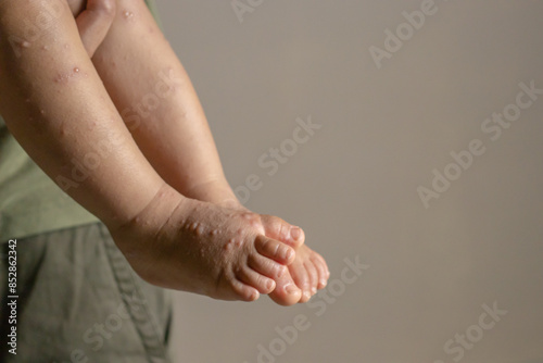 Close-up of a child's feet infected with hand-foot-mouth disease or HFMD originating from enterovirus or coxsackie virus, copy space on the right