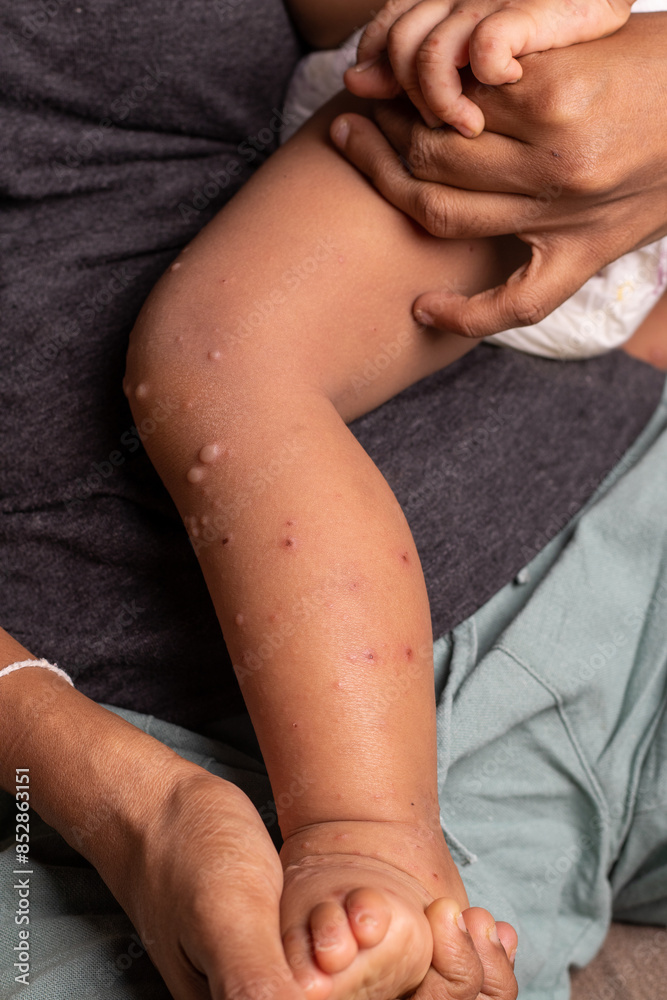Close-up of a mother holding a leg of a child infected with hand-foot-mouth disease or HFMD originating from enterovirus or coxsackie virus