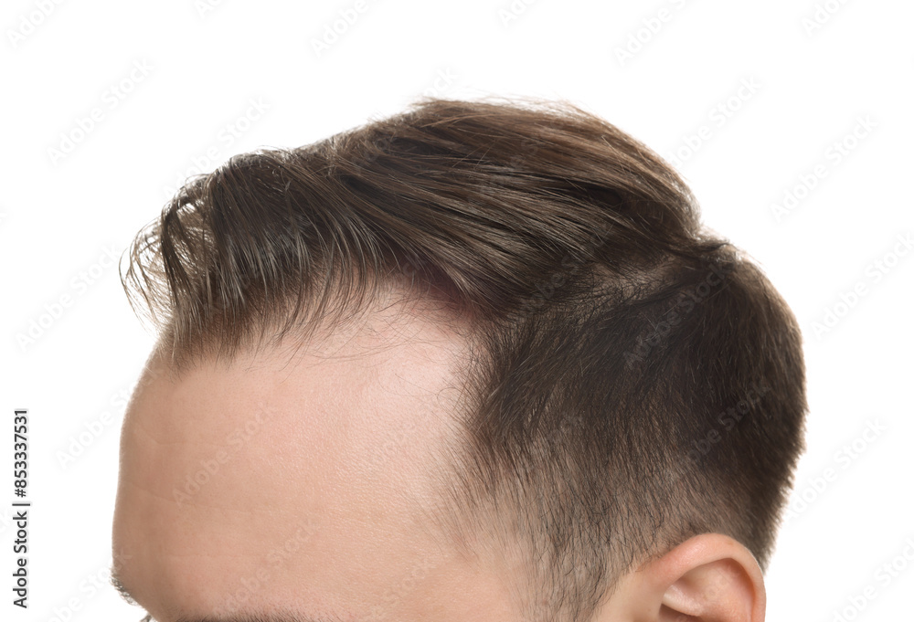 Baldness concept. Man with receding hairline on white background, closeup Baldness concept. Man with receding hairline on white background, closeup