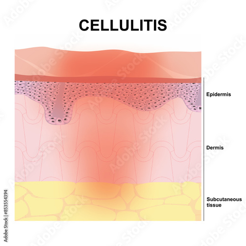 Cellulitis illustration skin care vector