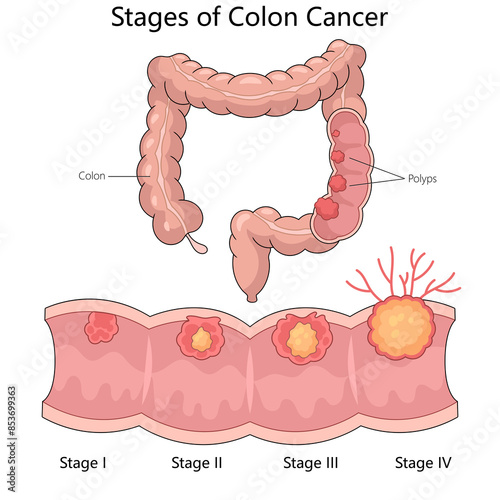 stages of colon cancer with labeled polyps and colon anatomy from stage I to stage IV diagram hand drawn schematic raster illustration. Medical science educational illustration
