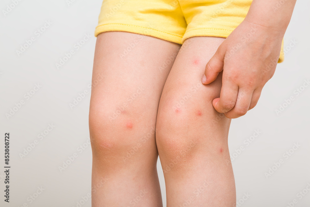 Toddler girl hand fingers itching red rash on leg skin from bite of mosquito or food allergy isolated on light gray background. Front view. Closeup. Toddler girl hand fingers itching red rash on leg skin from bite of mosquito or food allergy isolated on light gray background. Front view. Closeup.