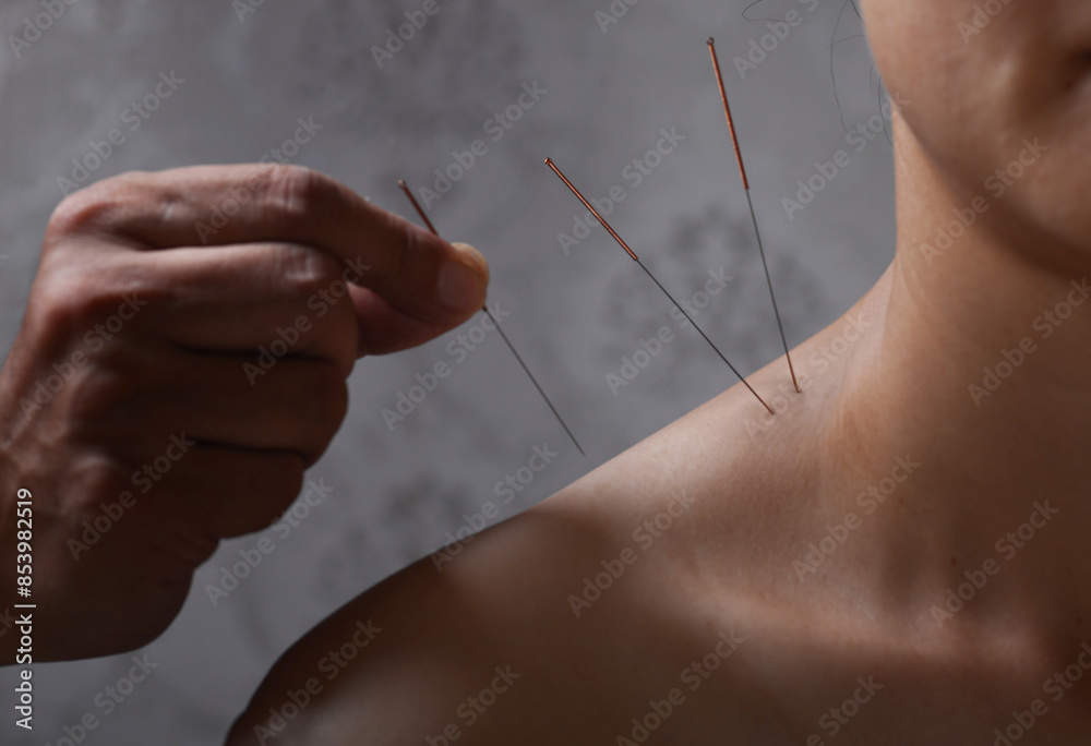 Doctors perform acupuncture and moxibustion treatment for women's shoulders