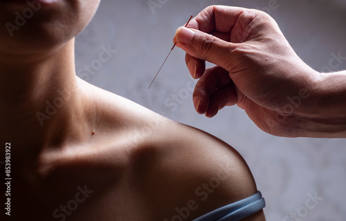 Doctors perform acupuncture and moxibustion treatment for women's shoulders