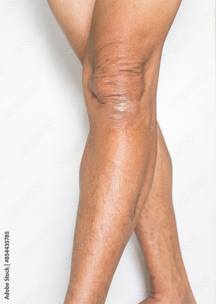 The leg and knee muscles of an old man who has arthritis problems and the bones and joints of the body on a white background
