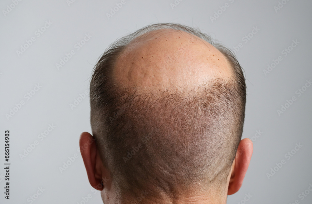 close up of a person bald head with hair loss problem close up of a person bald head with hair loss problem