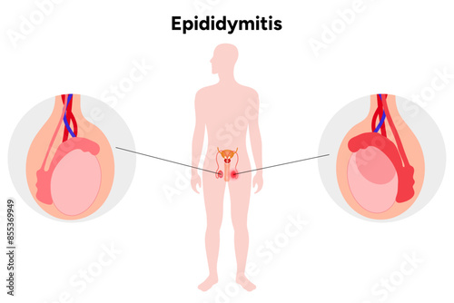 Male reproductive system Epididymitis medical infographic photo
