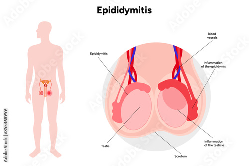 Medical diagram Epididymitis mans disease photo