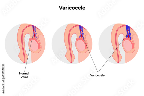 Normal vein Varicocele zoom, medical infographic  photo