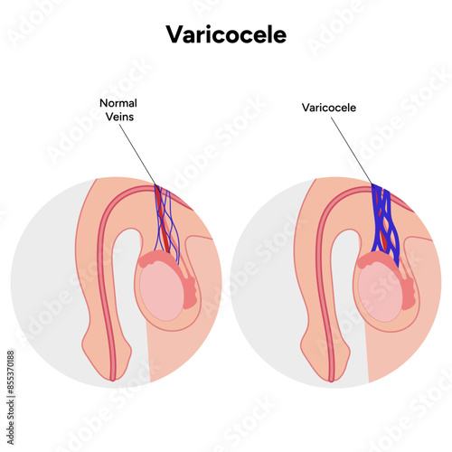 Varicocele zoom, medical diagram   photo