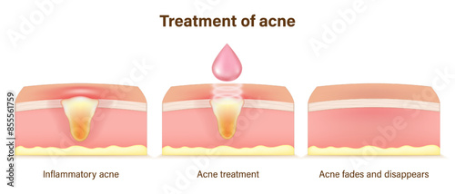 Treatment of acne. Skin layers before, during and after treatment. Acne skin and healthy skin. Treating acne with acne serum.