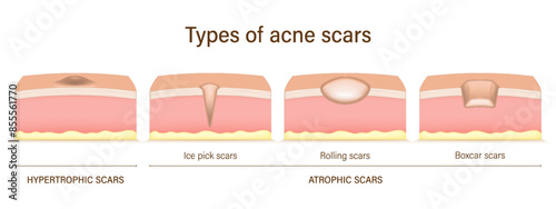 Types of acne scars. Facial skin problems. Hypertrophic scars and Atrophic scars. Vector for advertising about beauty and medical treatment. Acne scar analysis. photo