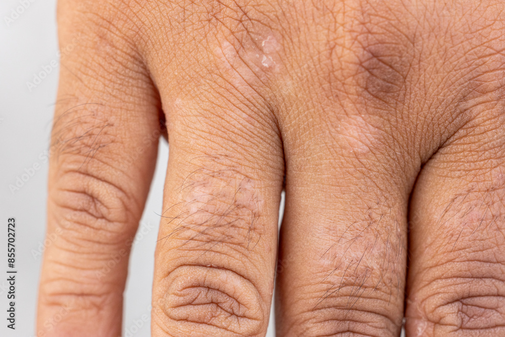 Background image of wounds caused by Systemic Lupus erythematosus (SLE) or Lupus. Background image of wounds caused by Systemic Lupus erythematosus (SLE) or Lupus.