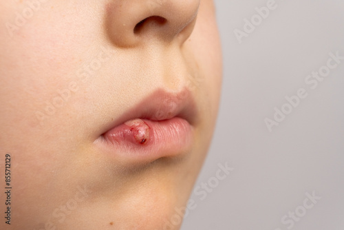 Foto Skin damage, wound, abrasion on the lip of a small child.