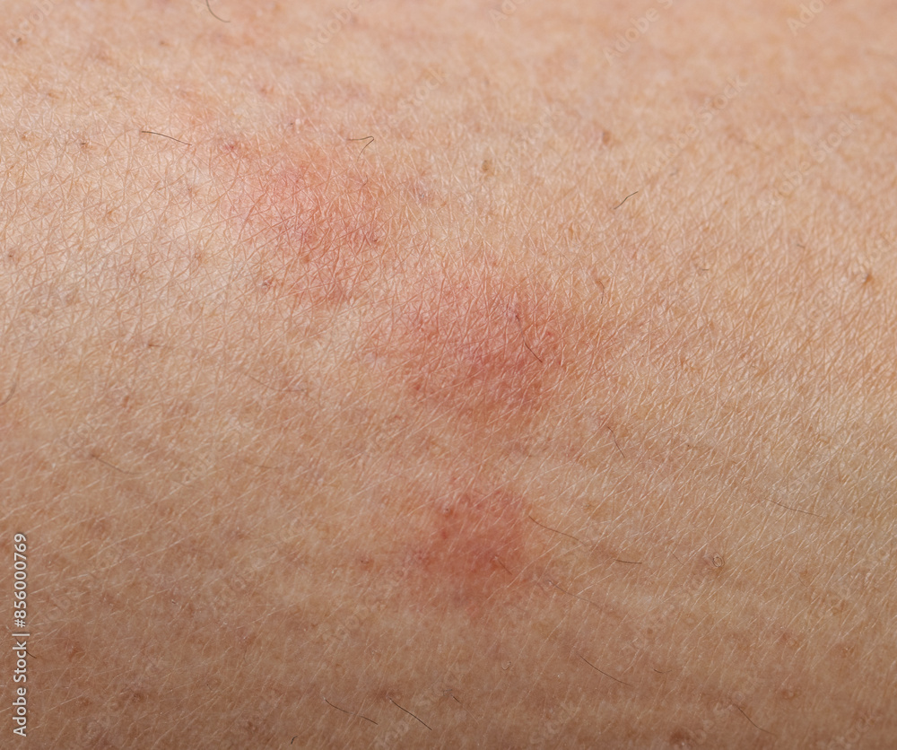 red spots from a mosquito bite. red spots from a mosquito bite.