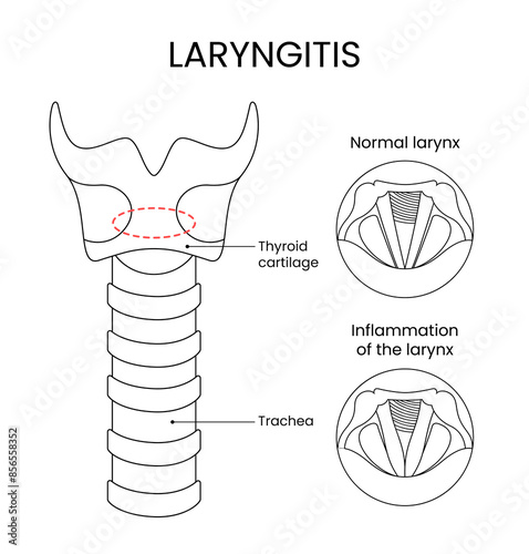 Laryngitis medical design with line style illustration