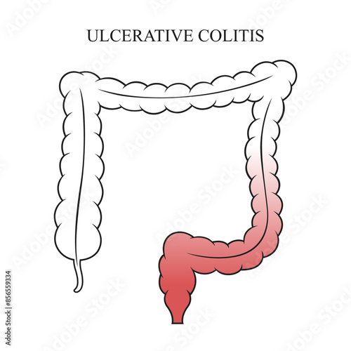 Ulcerative colitis medical design with line style illustration