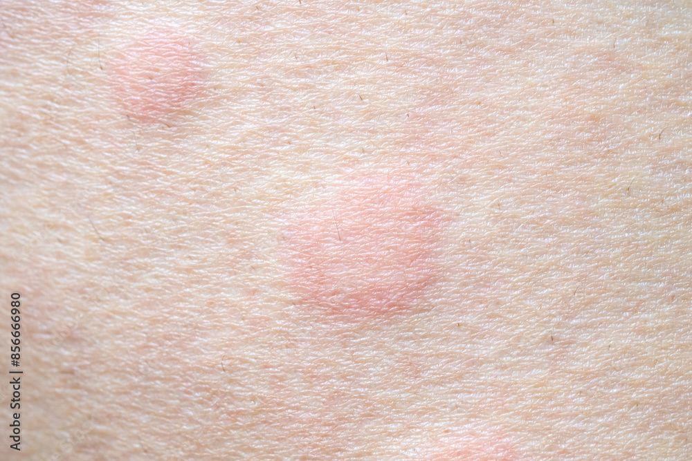 Fototapeta premium Skin allergy rash dermatitis texture close up