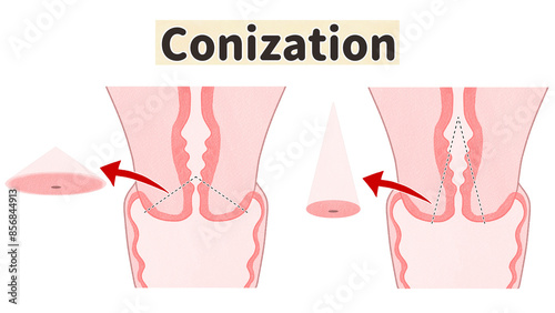 Cervical conization Medical diagram PNG photo