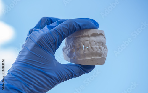 White plaster impression of the dental jaw of a patient with crooked teeth and malocclusion. Manufacturing of dentures and crowns based on orthodontic impressions photo