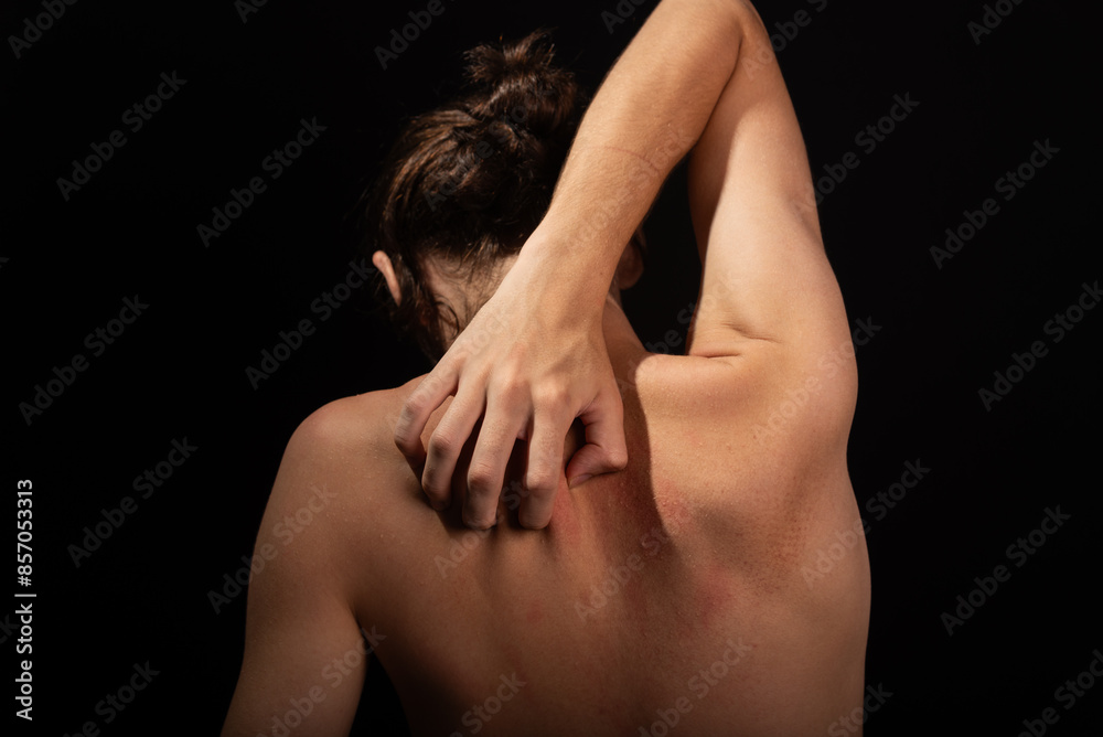 Young man, shirtless, scratching his back with his hands. Skin disease. Irritation, allergy.