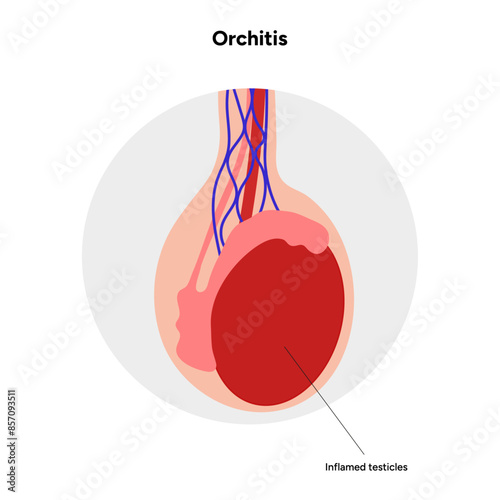 Male Orchitis Testis Inflamed 