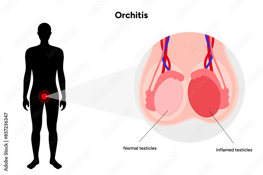 Male Orchitis Testis Inflamed and normal testicles with man mannequin ...
