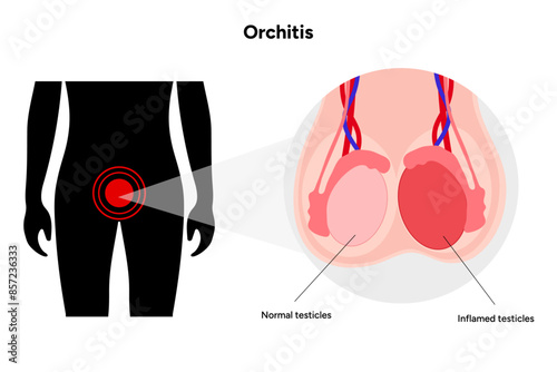 Male Orchitis Testis Inflamed and normal testicles with man mannequin
