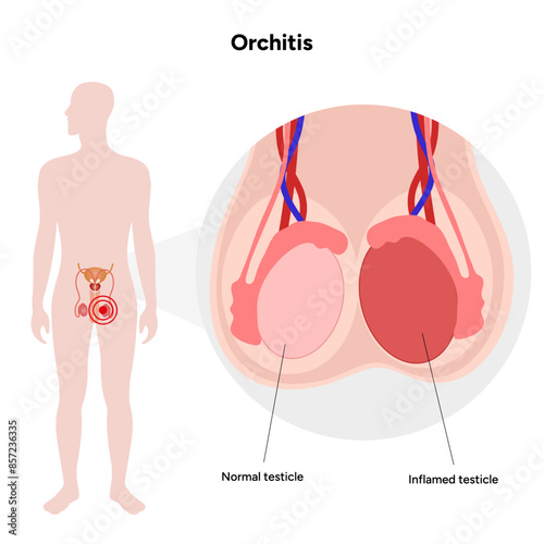 Male Orchitis Testis Inflamed and normal testicles with man mannequin
