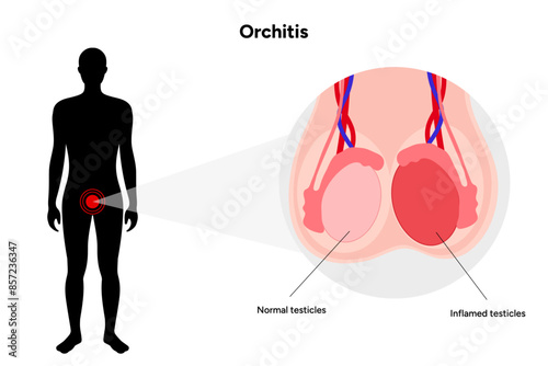 Male Orchitis Testis Inflamed and normal testicles with man mannequin