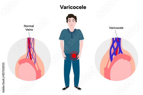 Varicocele male disease 