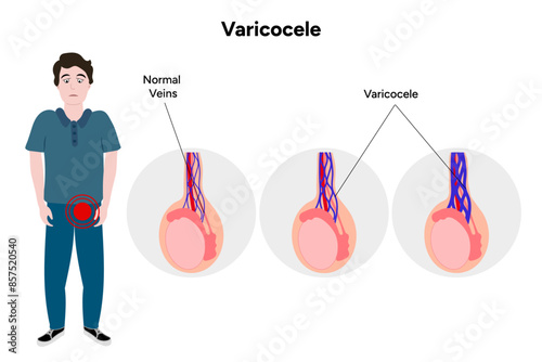Varicocele male disease 